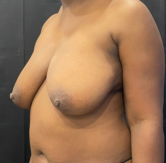 Case--8854 | Before Breast Reduction 2