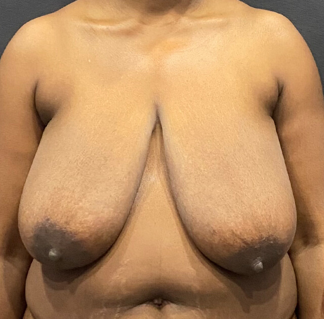 Case--5780 | Before Breast Reduction