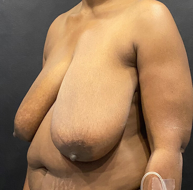 Case--5780 | Before Breast Reduction 2