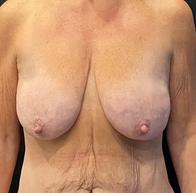 Case--2763 | Before Breast Reduction