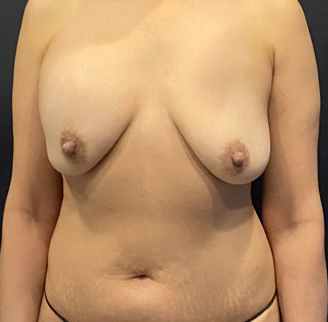 Case--8305 | Before Breast Revision