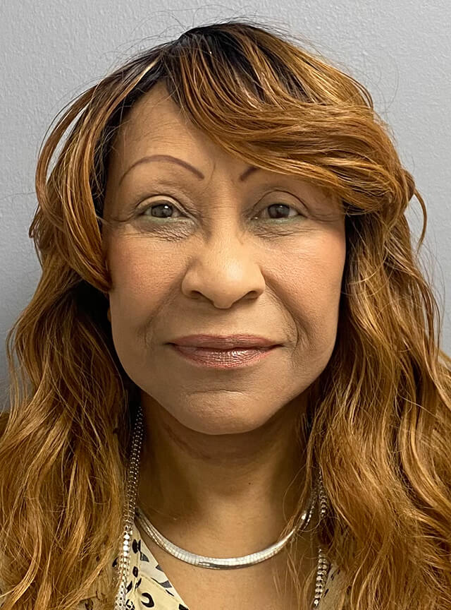 Case--1306 | After Facelift and Neck Lift