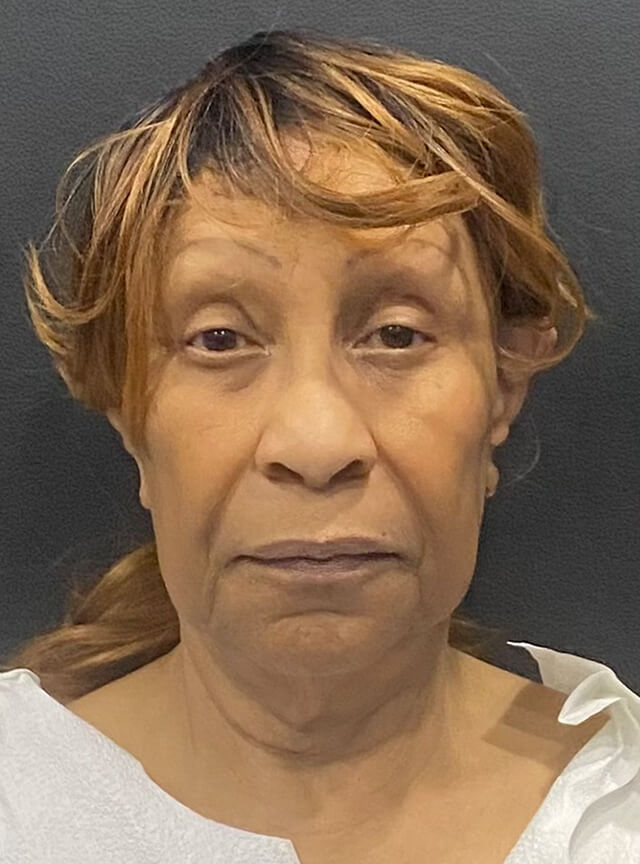 Case--1306 | Before Facelift and Neck Lift