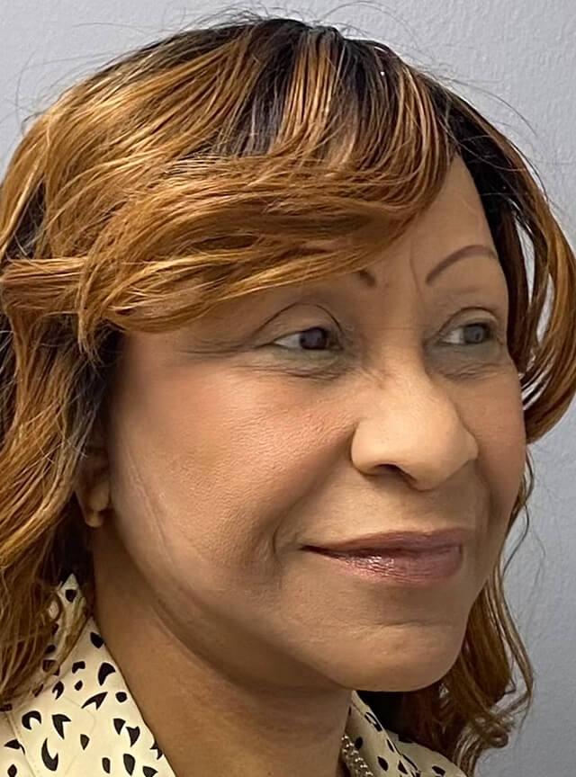 Case--1306 | After Facelift and Neck Lift 2