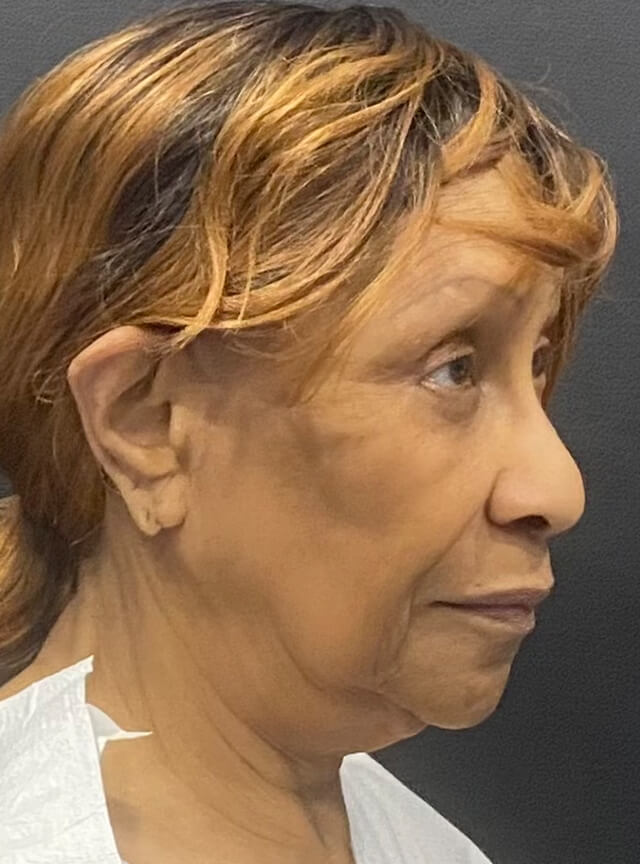 Case--1306 | Before Facelift and Neck Lift 2