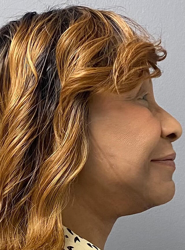 Case--1306 | After Facelift and Neck Lift 3