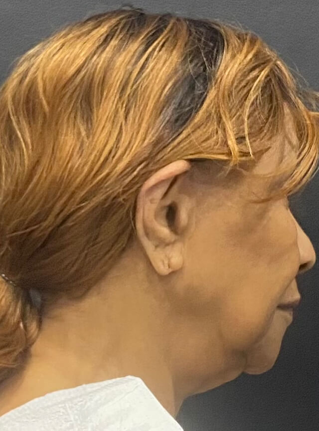 Case--1306 | Before Facelift and Neck Lift 3