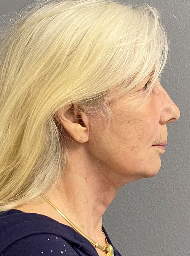 Case--1353 | After Facelift and Neck Lift