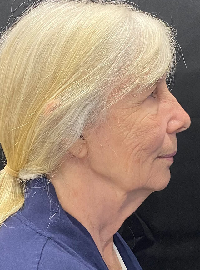 Case--1353 | Before Facelift and Neck Lift