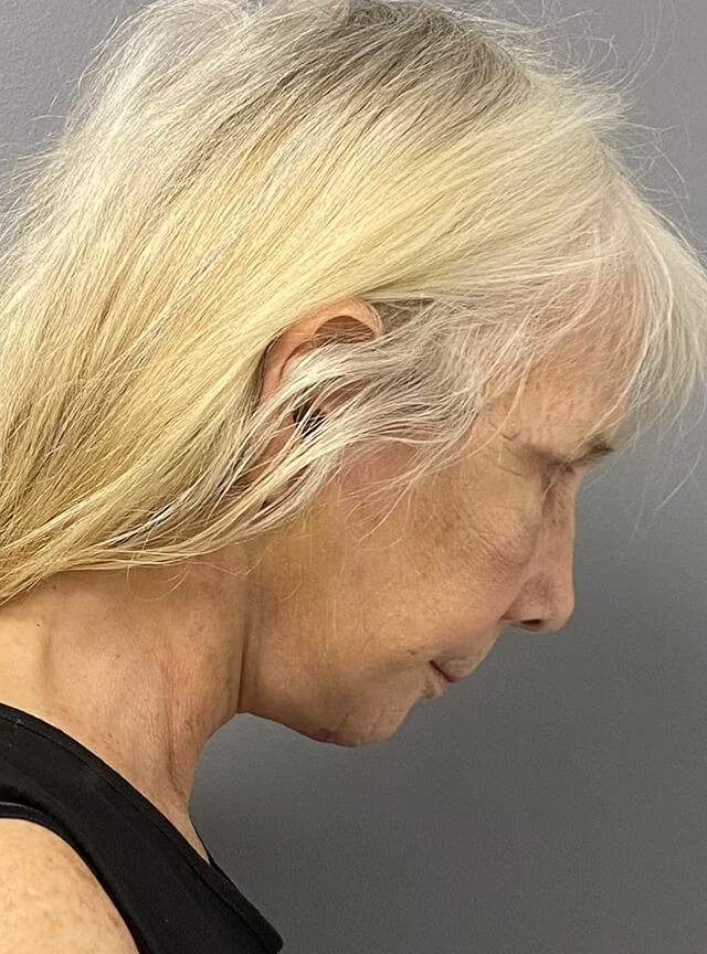 Case--1353 | After Facelift and Neck Lift 2
