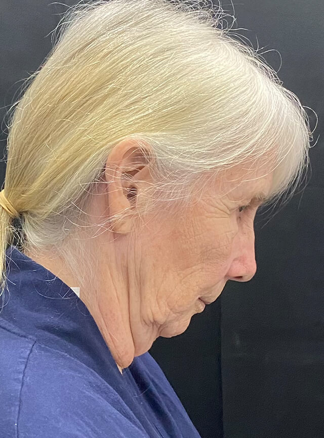 Case--1353 | Before Facelift and Neck Lift 2