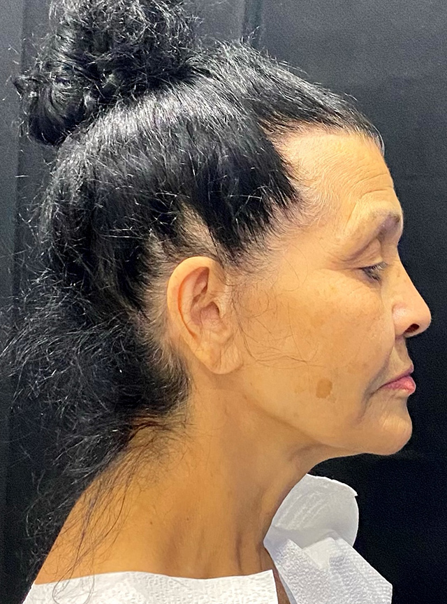 Case--4392 | Before Facelift and Neck Lift