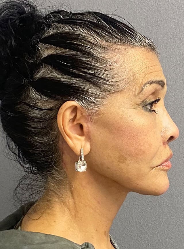 Case--4392 | After Facelift and Neck Lift