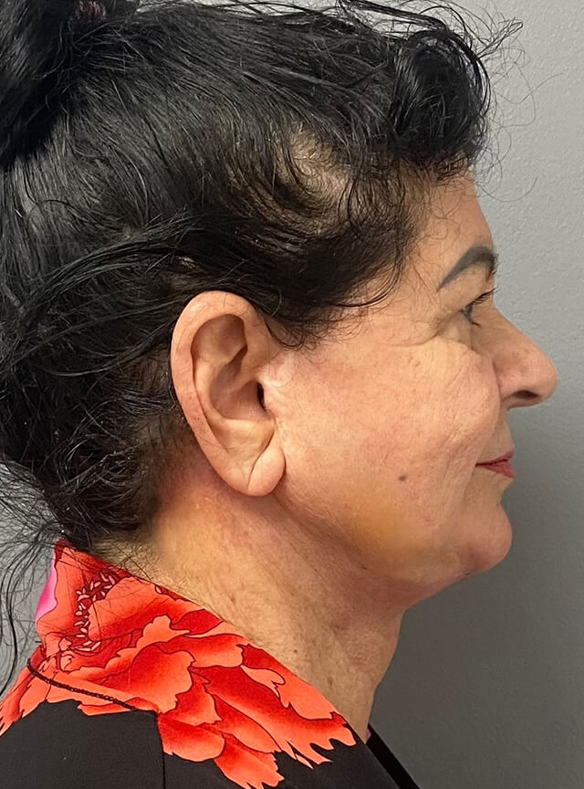 Case--2780 | After Facelift and Neck Lift