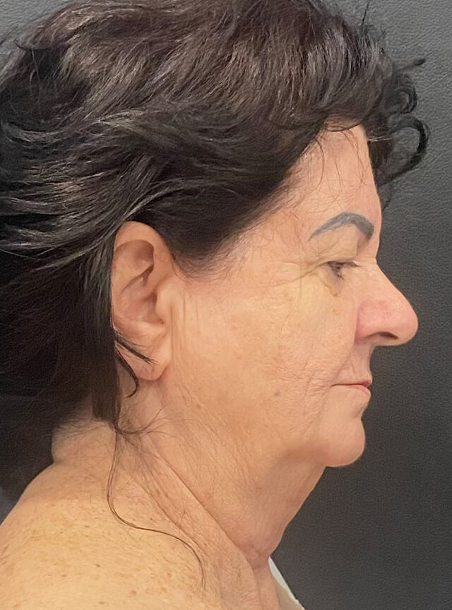 Case--2780 | Before Facelift and Neck Lift
