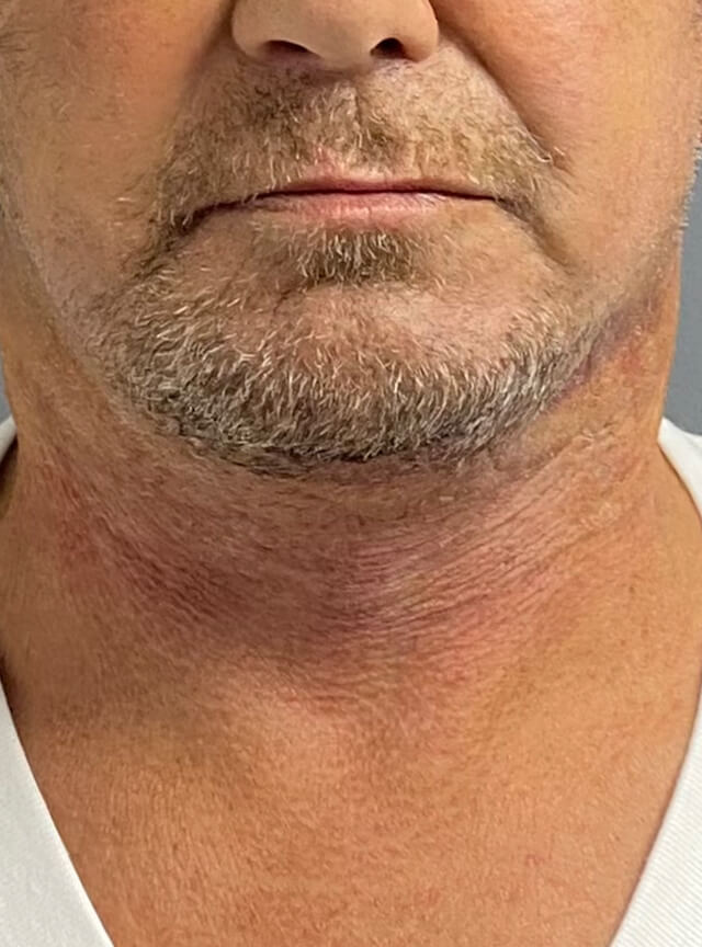 Case--6525 | After Facelift and Neck Lift