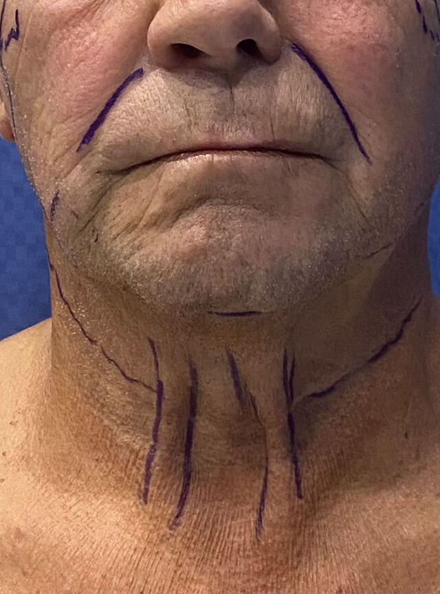 Case--6525 | Before Facelift and Neck Lift