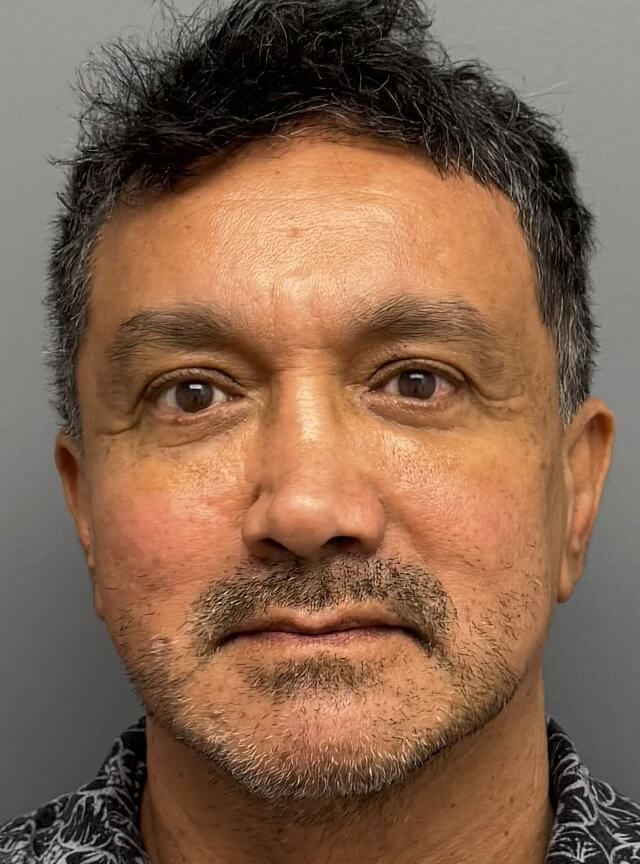 Case--6212 | After Fat Transfer