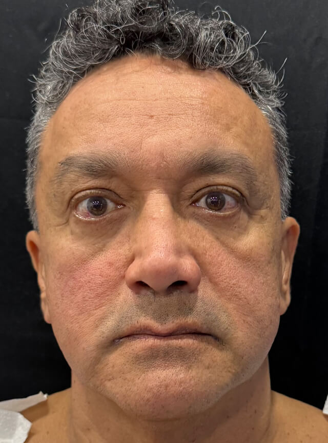 Case--6212 | Before Fat Transfer