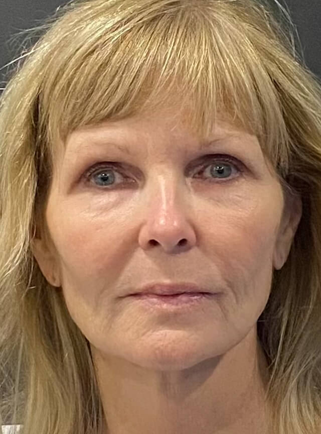 Case--9441 | Before Fat Transfer