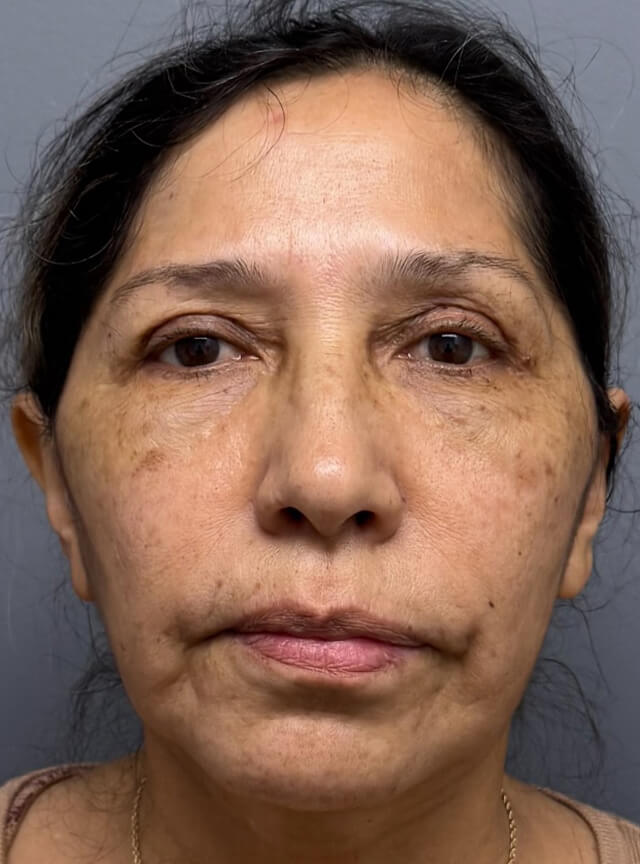 Case--6264 | After Fat Transfer