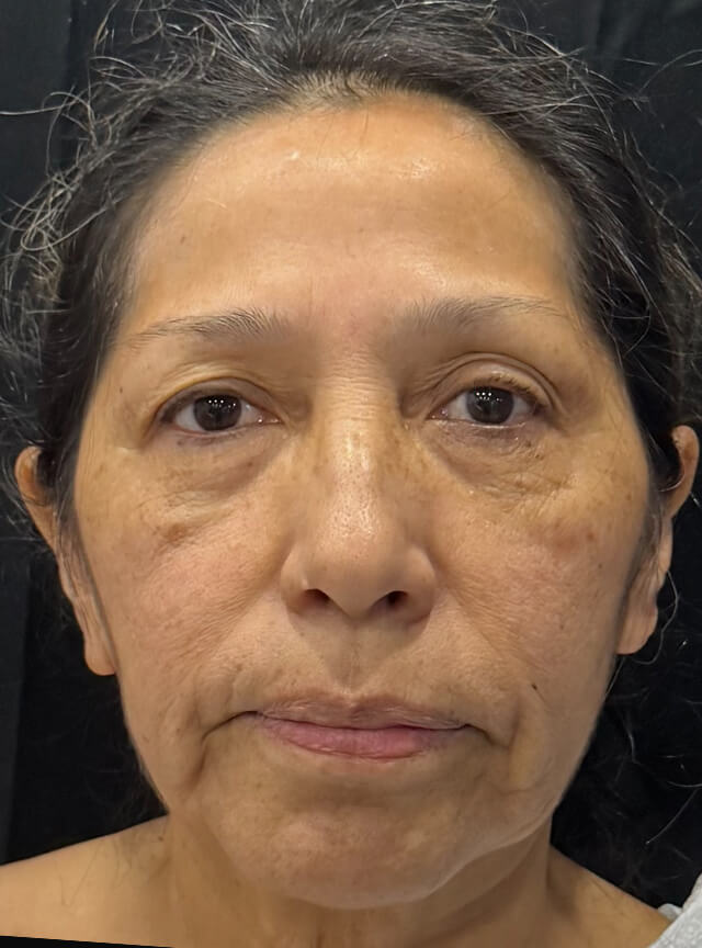 Case--6264 | Before Fat Transfer