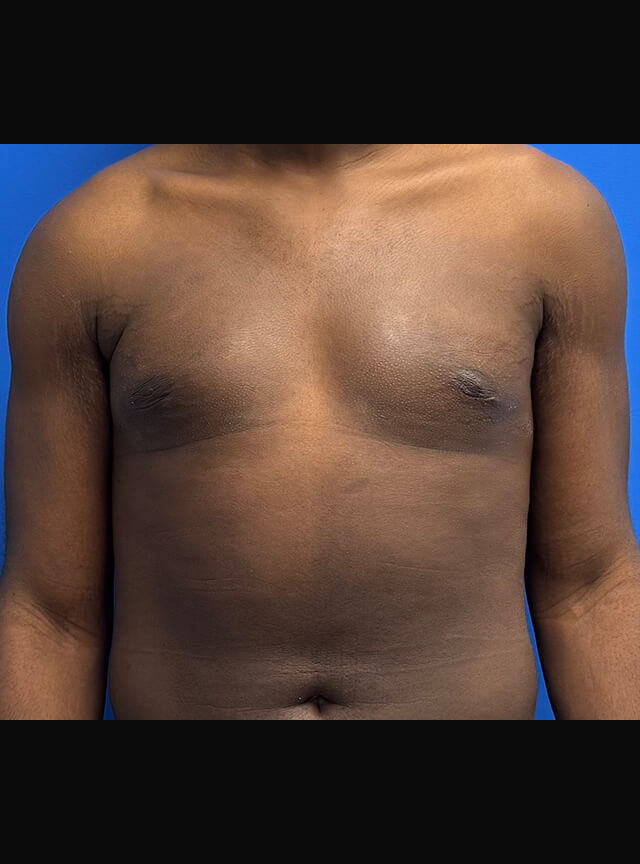 Case--4145 | After Gynecomastia