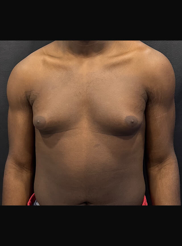 Case--4145 | Before Gynecomastia