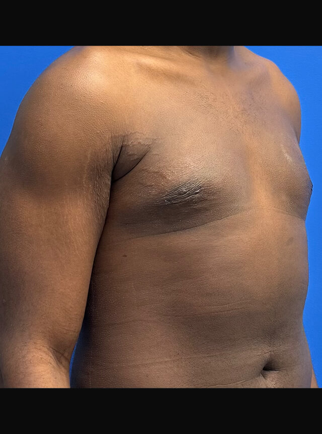 Case--4145 | After Gynecomastia 2
