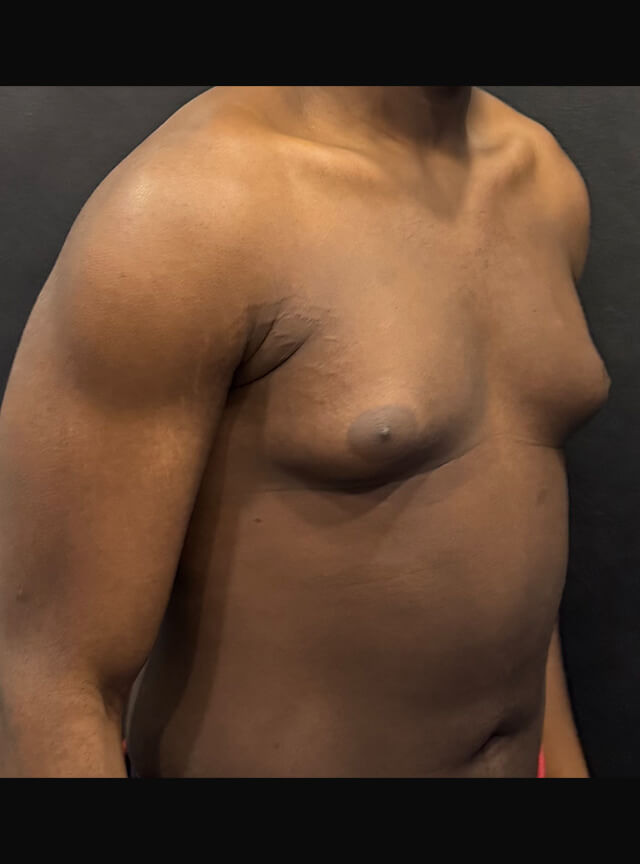 Case--4145 | Before Gynecomastia 2