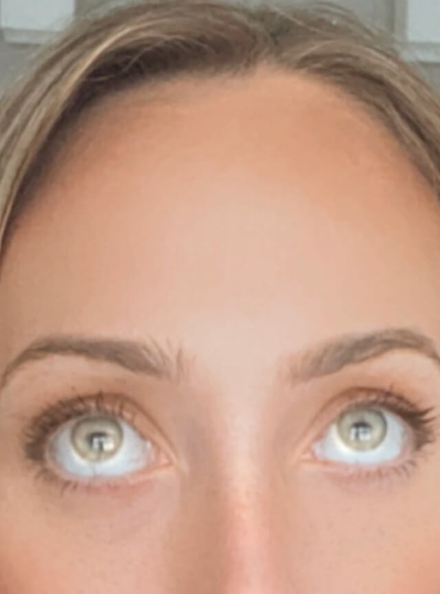 Case--6868 | After Injectables