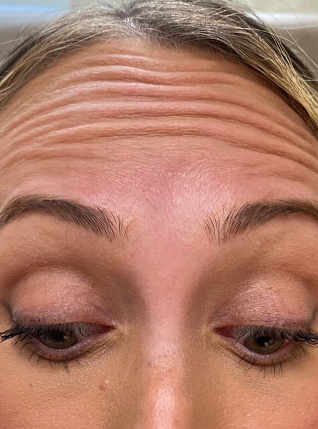 Case--6868 | Before Injectables