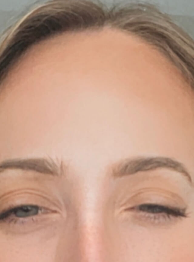 Case--6868 | After Injectables 2