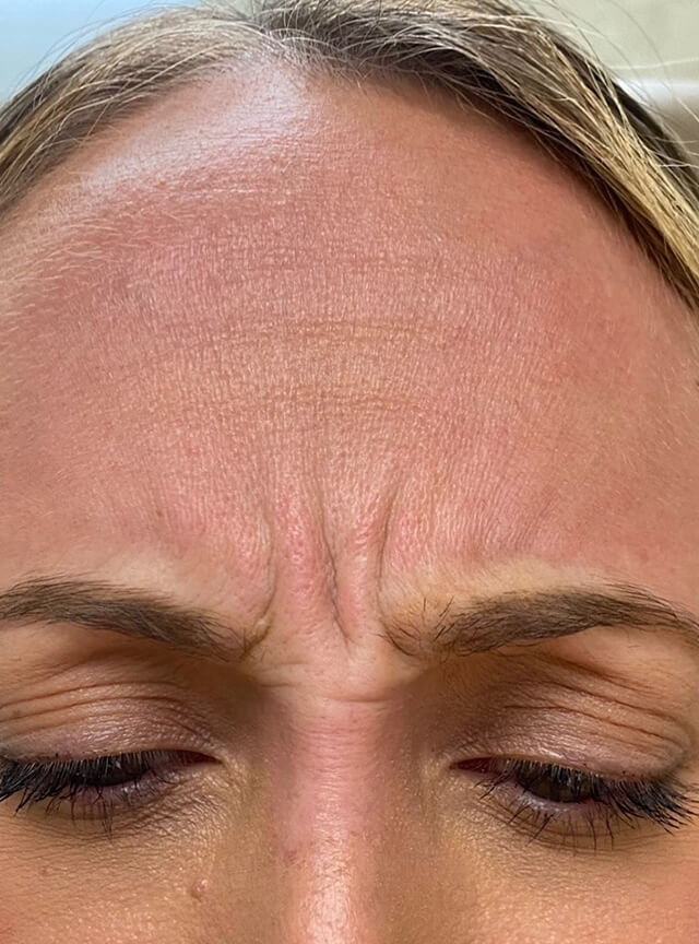 Case--6868 | Before Injectables 2