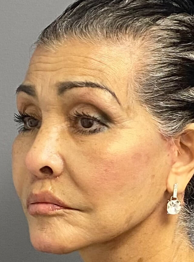 Case--5030 | After Lip Lift