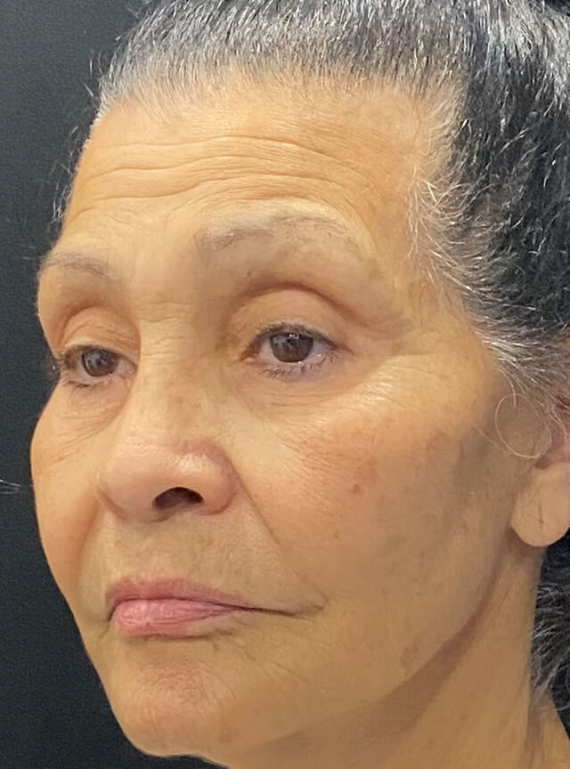 Case--5030 | Before Lip Lift