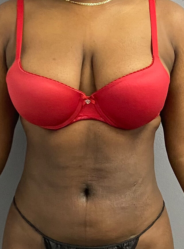 Case--9187 | After Liposuction