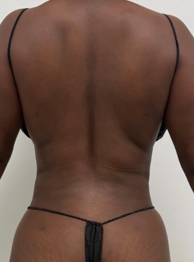 Case--5097 | After Liposuction