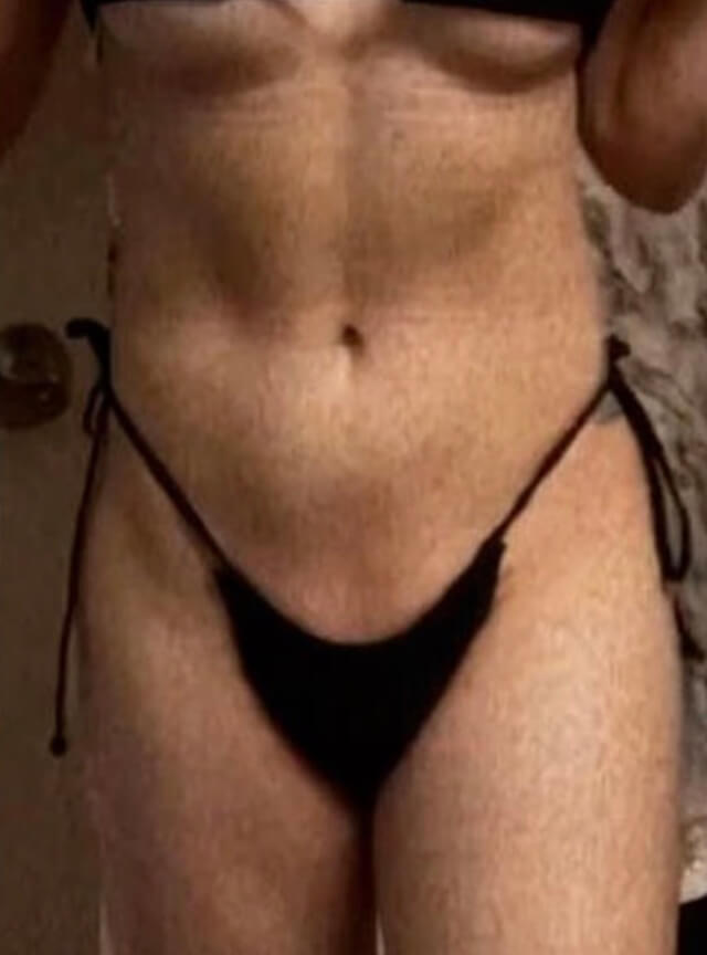 Case--1561 | After Liposuction