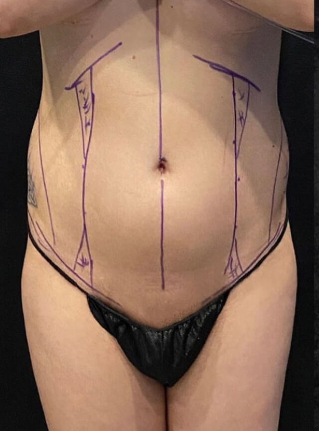 Case--1561 | Before Liposuction