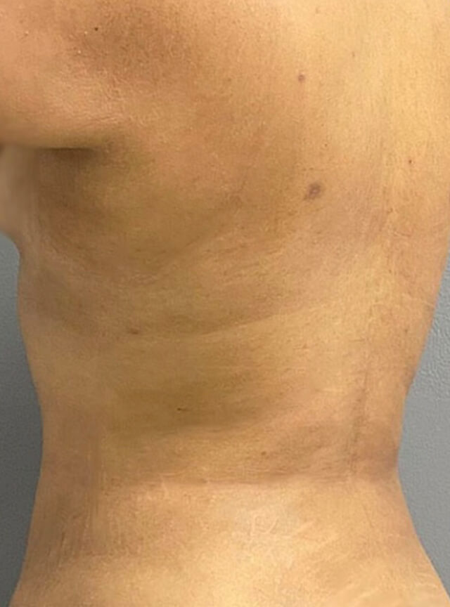 Case--1742 | After Liposuction