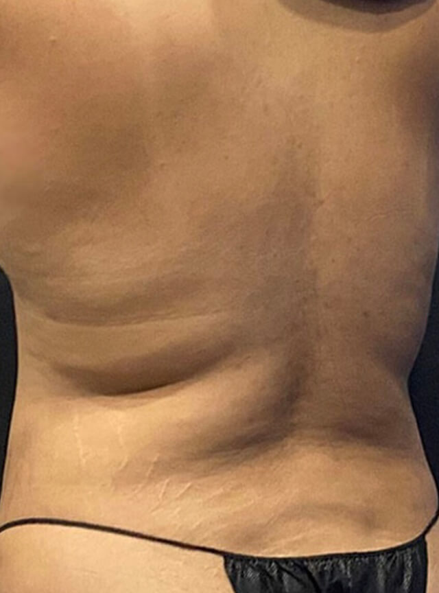 Case--1742 | Before Liposuction