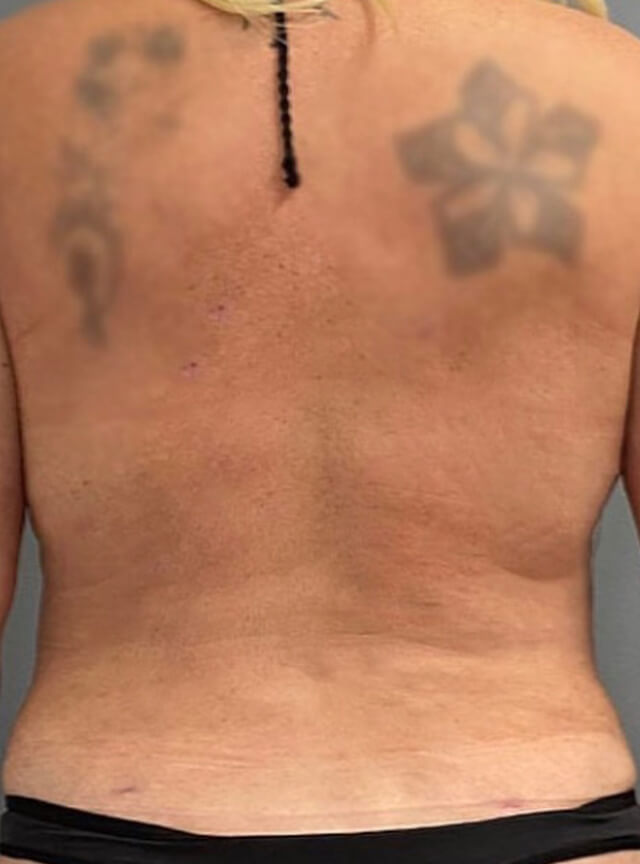 Case--6913 | After Liposuction