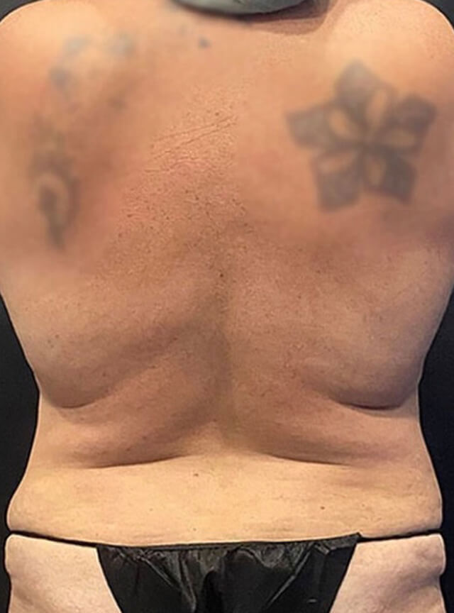 Case--6913 | Before Liposuction