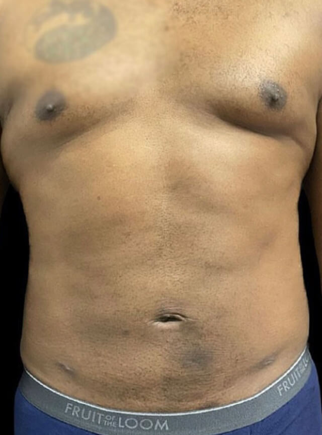 Case--9672 | After Liposuction