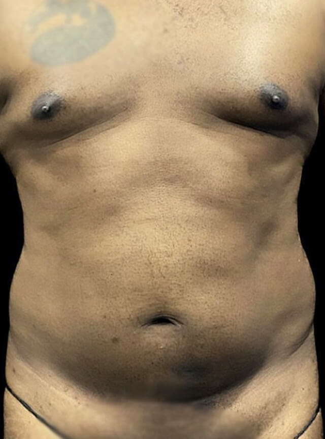 Case--9672 | Before Liposuction