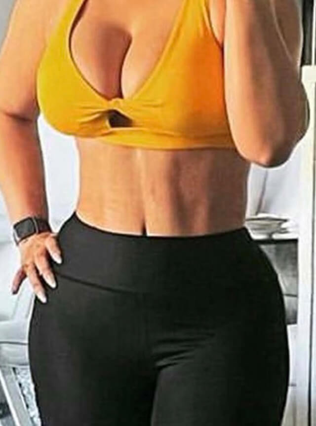 Case--3057 | After Liposuction