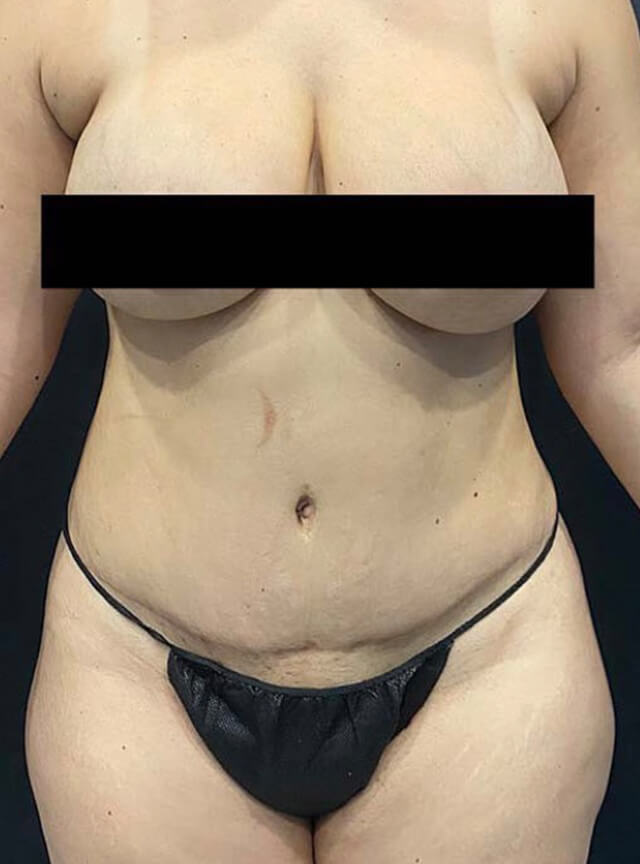 Case--3057 | Before Liposuction