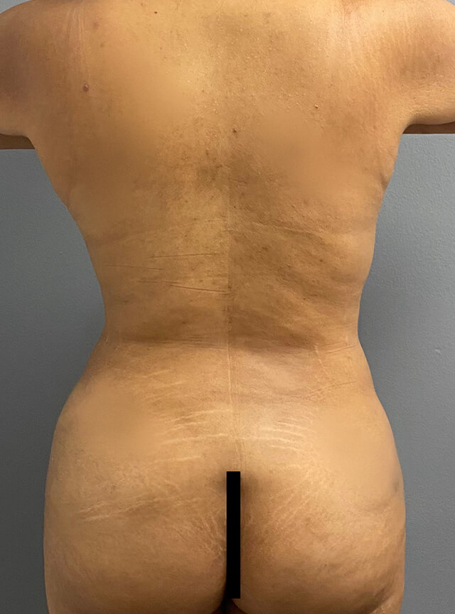 Case--3031 | After Liposuction