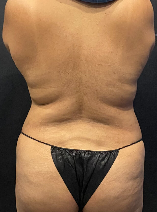 Case--3031 | Before Liposuction